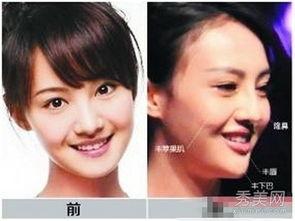 郑州整形失败爆料事件视频,揭秘美容行业潜规则与风险  第3张